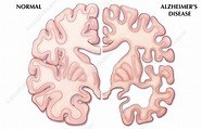 BRAIN
